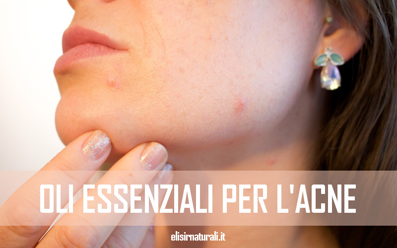 oli essenziali per acne