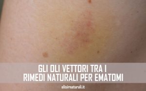 gli oli vettori tra i rimedi naturali per ematomi